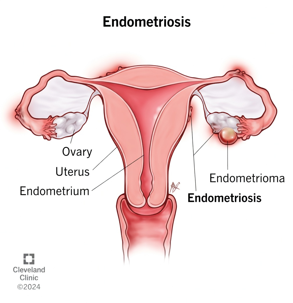 What Is Endometriosis and Why Should Every Woman Know About It?
