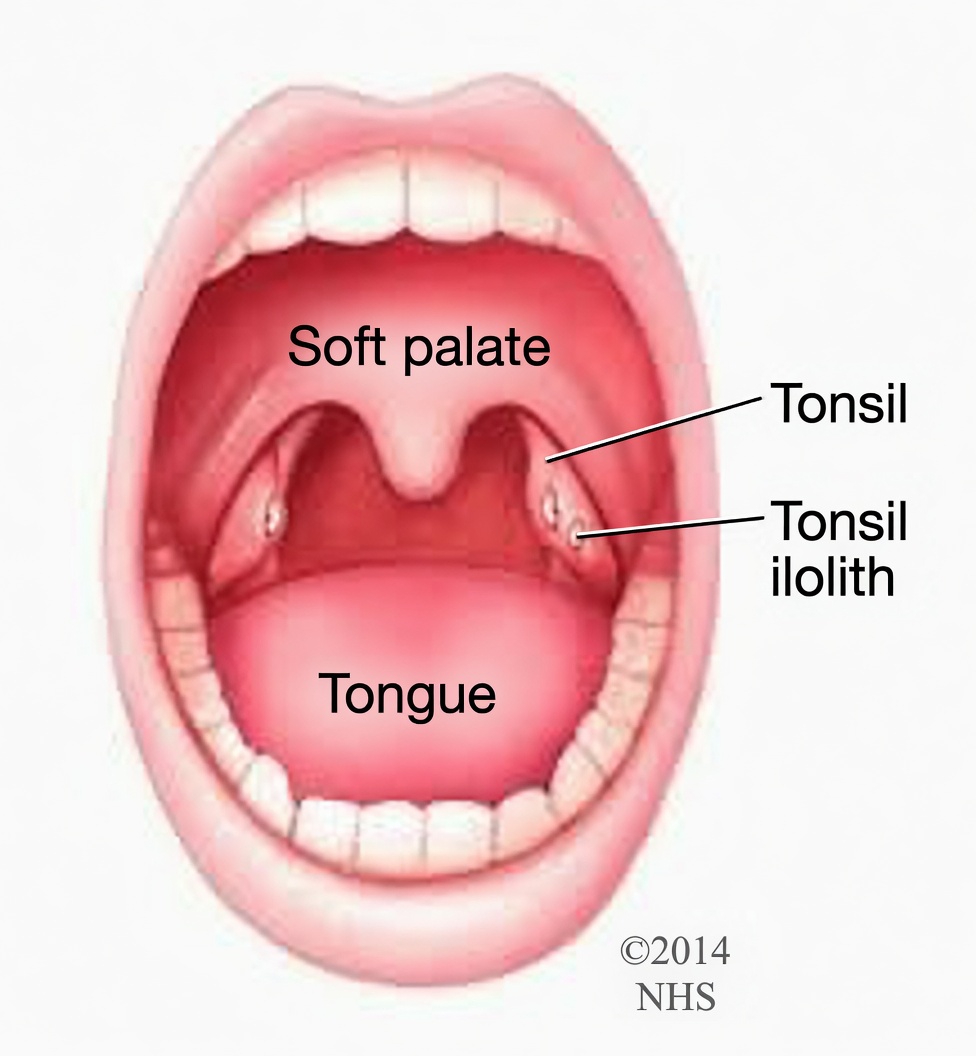 What Is That Small Lump That Came Out of Your Throat After Sneezing? Understanding Tonsil Stones