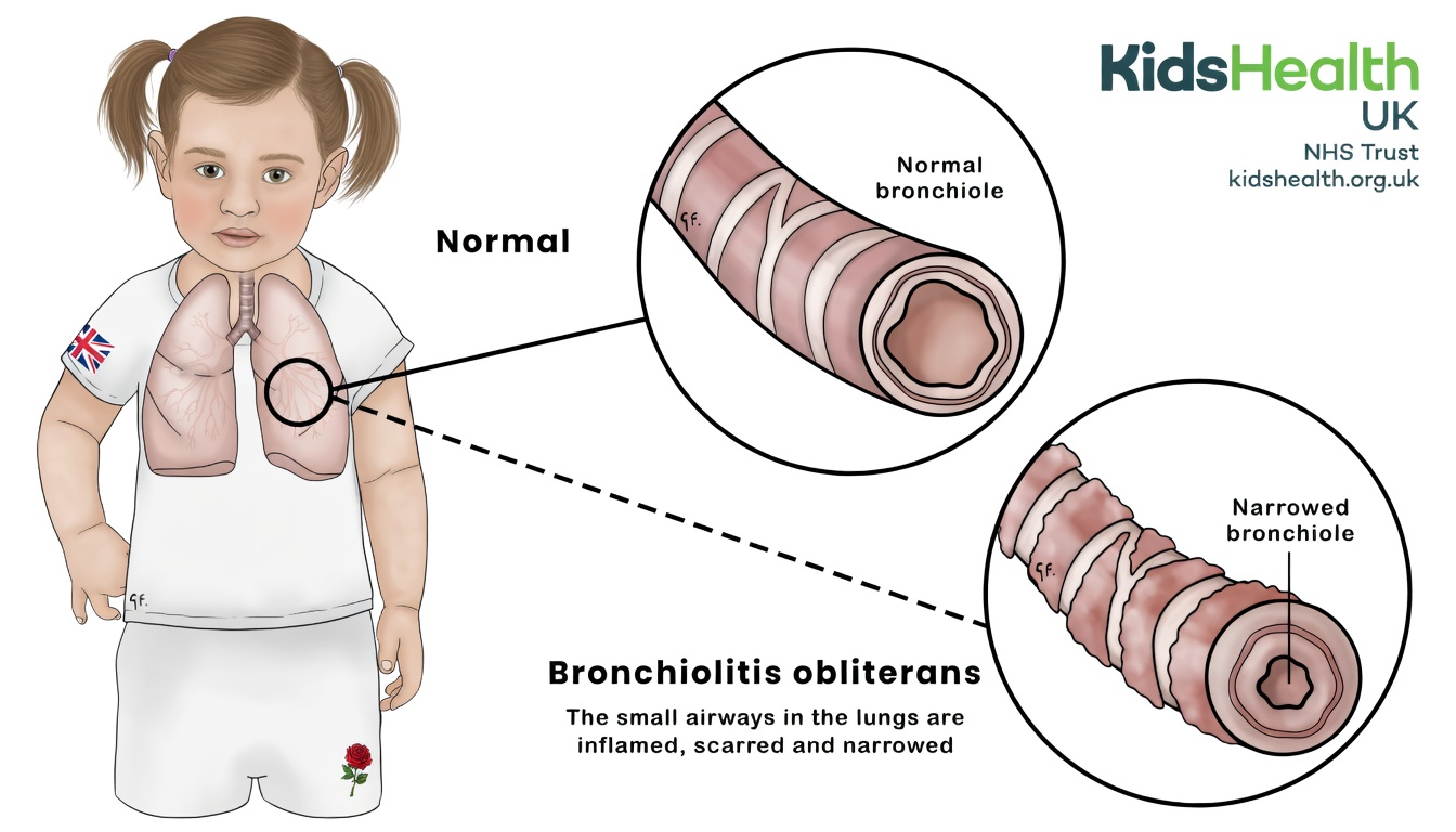 Vaping and Popcorn Lung: A Quiet Risk Many Adults Still Ignore