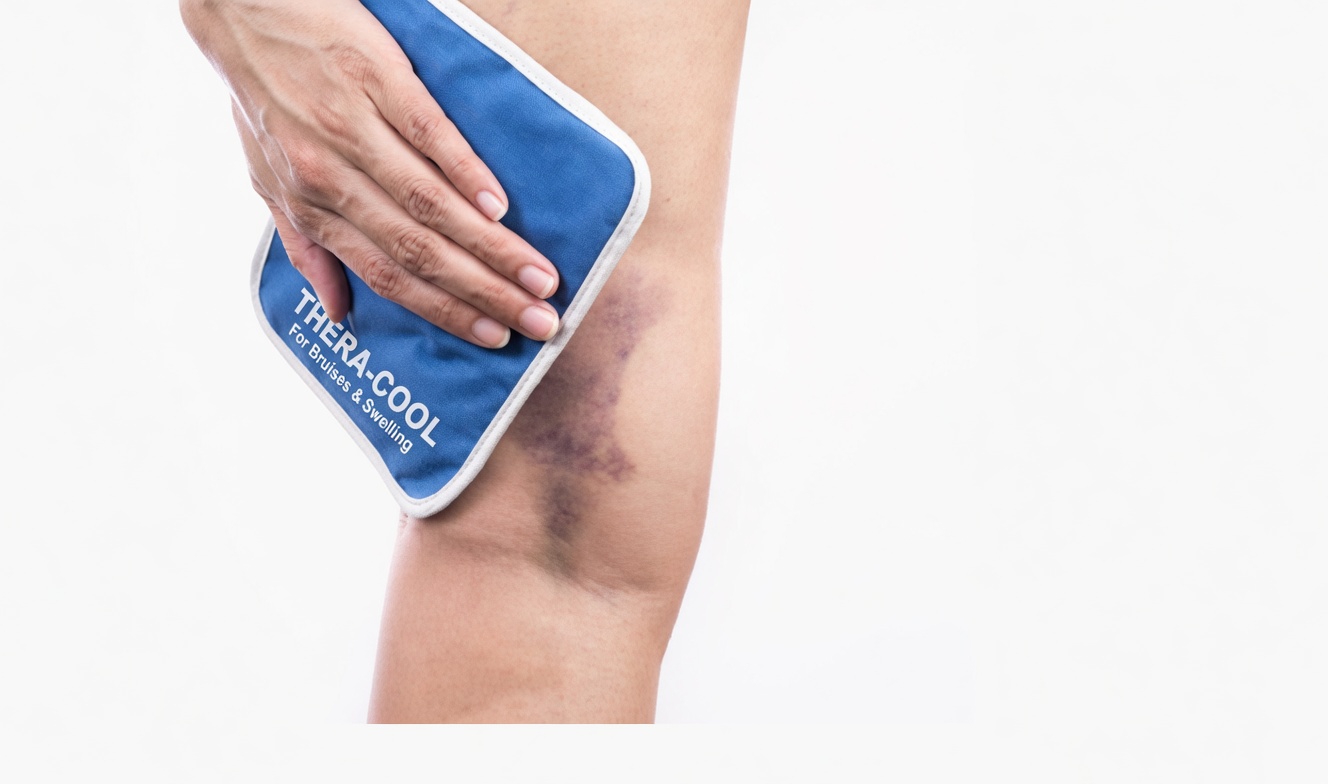 What Does the Color of Your Bruise Mean? A Warning Your Body May Be Sending