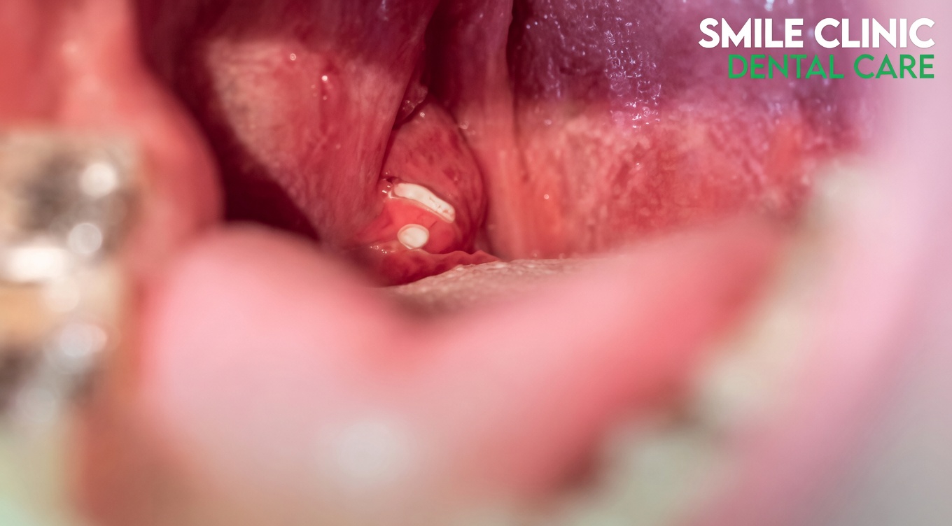 Tonsil Stones: What They Are and Why They Might Be Behind Your Persistent Bad Breath