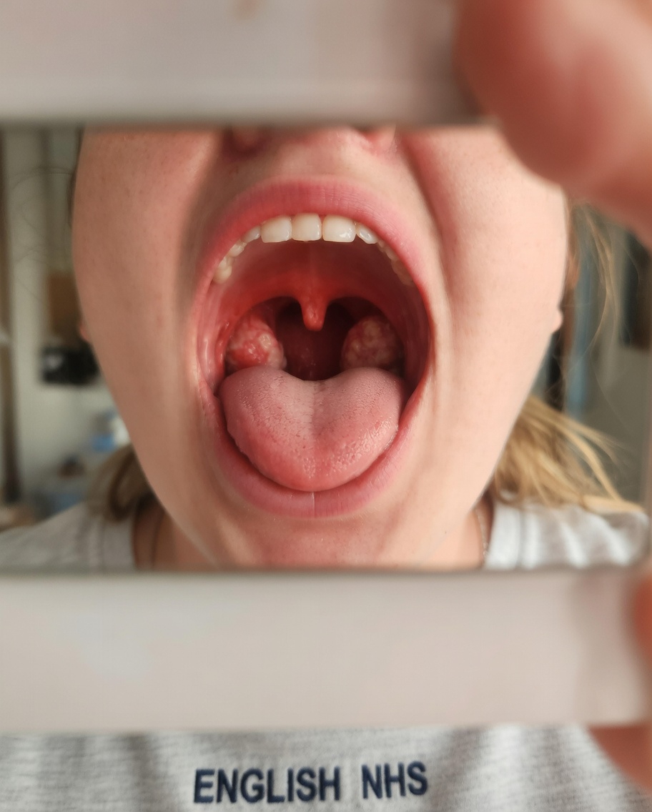 What Are the Different Types of Throat Infections and How Can You Spot the Signs Early?