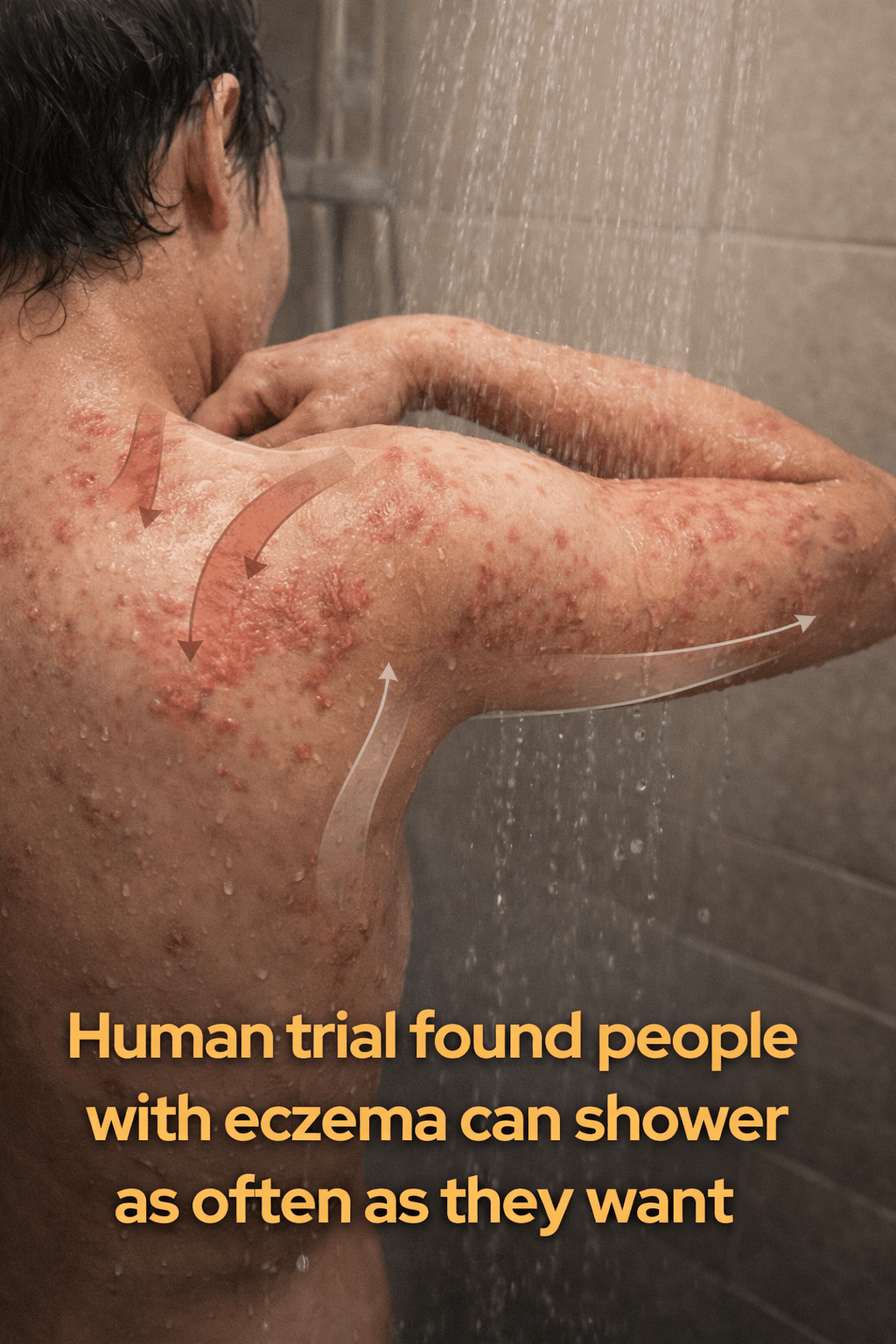 Is Daily Showering Safe for Eczema? New Research Challenges an Old Fear