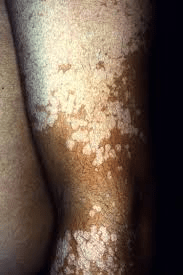 Why Do Small White Spots Appear on Your Arms and Legs? Understanding This Common Skin Change