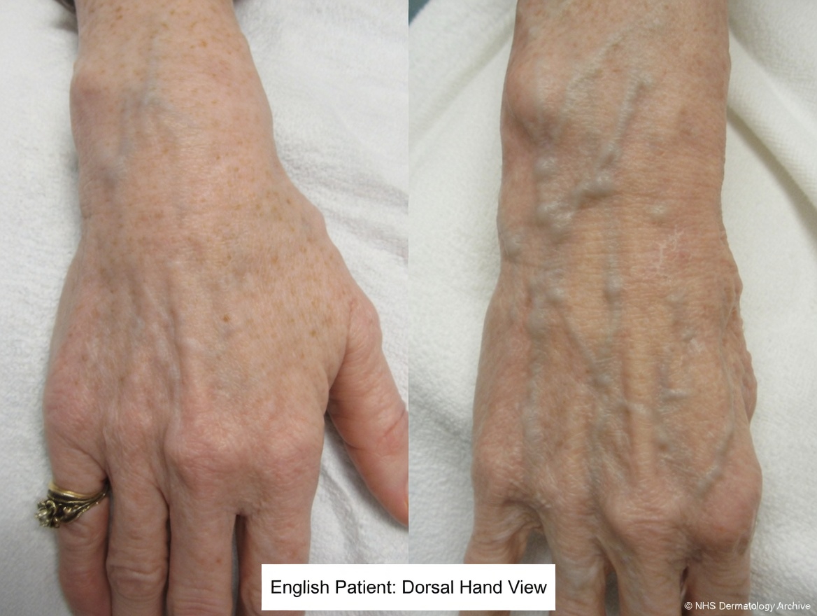 10 Natural Ways to Get Rid of Varicose Veins and Boost Blood Flow Naturally